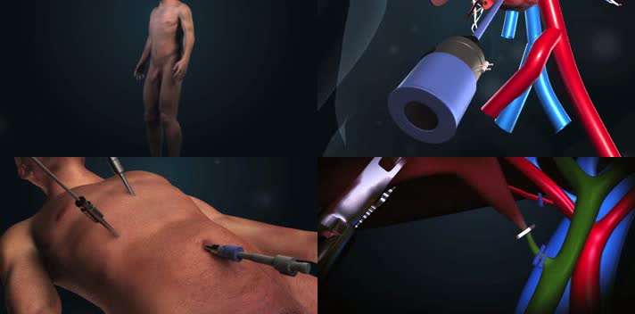 医疗3D动画-腹腔镜胆囊切除手术