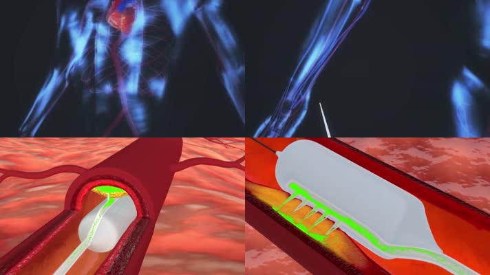 冠状动脉造影微针医学动画示例
