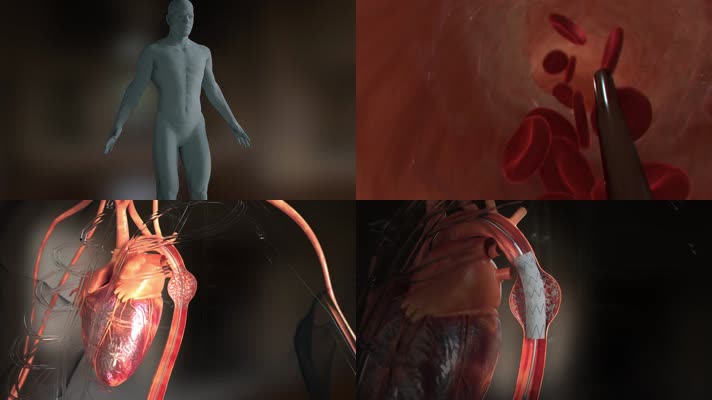 心脏血管医疗动画