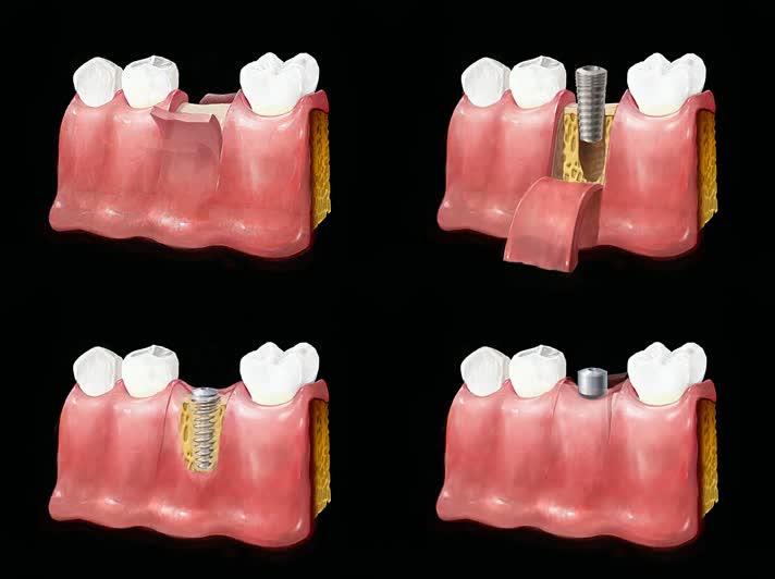 牙齿手术种植牙，三维动画演示过程