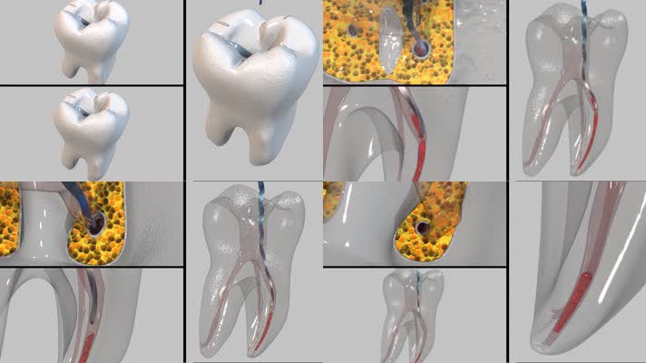 牙科手术三维动画