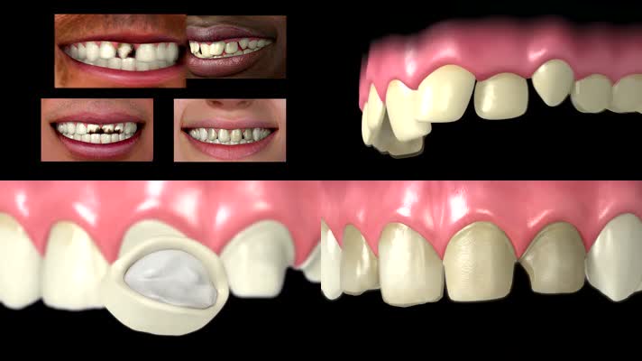 牙齿种植修复