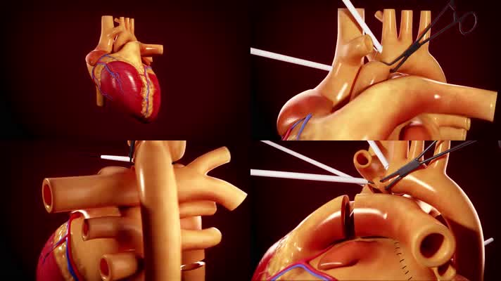心脏移植的医学动画