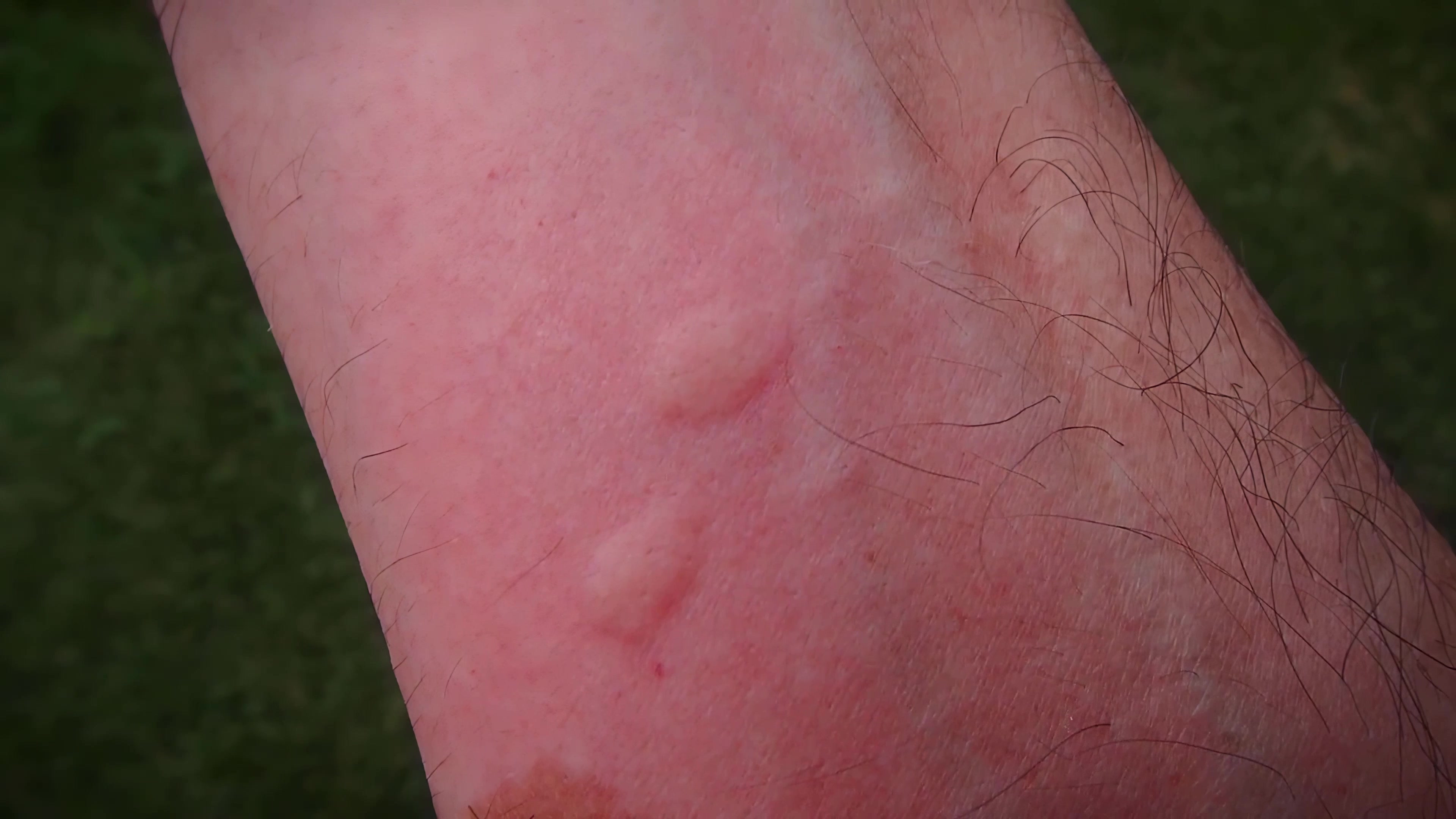 被毒蚊子咬后如何快速消肿止痒？