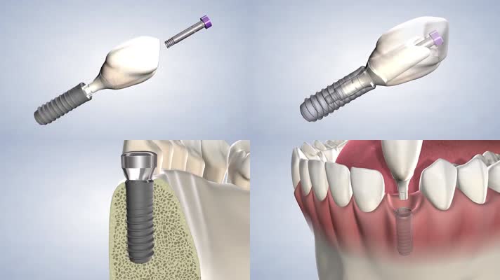 假牙植入牙齿种植动画视频素材