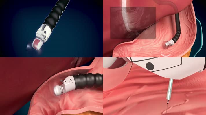 超声波胃肠镜手术医学三维动画