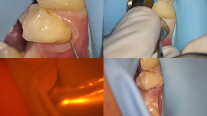 牙齿手术，填补牙洞牙龈龋齿