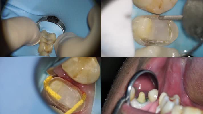 牙齿手术，牙齿打磨补牙