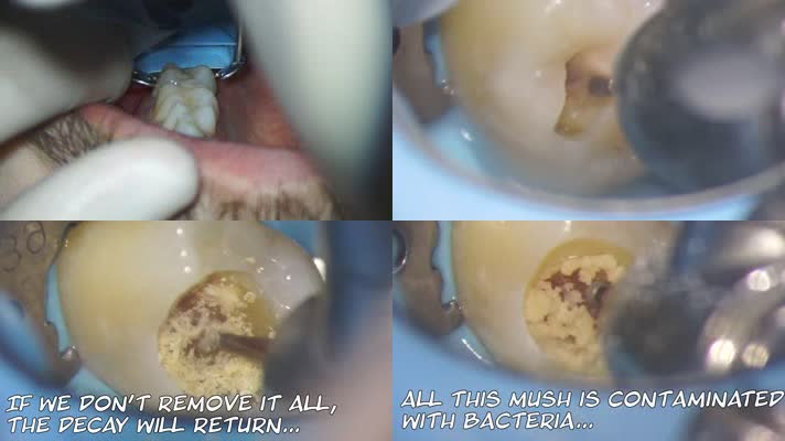 牙齿手术，蛀牙打磨填充