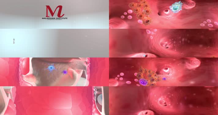 N0243-4K黑色素瘤治疗人体医疗动画